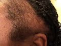 Update on hairline growth [mtg]