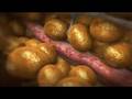 videos de 3D medical animation cellulite - VelaShape by syneron