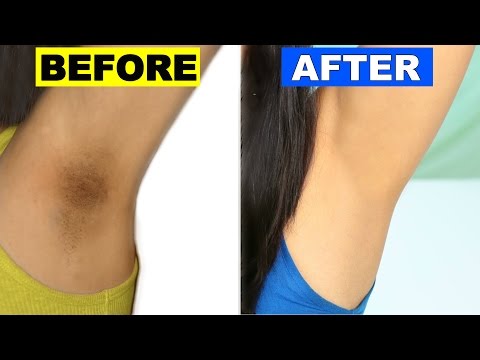How To Lighten Dark Underarms Permanently | Skincare Routine | ShrutiArjunAnand