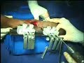 Rail Fixator in Aseptic Nonunion with deformity - Part 2