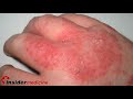 Insidermedicine in 60 - February 19, 2008  Dermatitis Antibiotics
