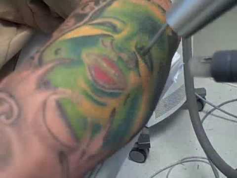 A buddha tattoo is removed in a laser tattoo removal treatment at Dr. 