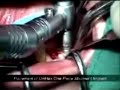 Full lower teeth replacement