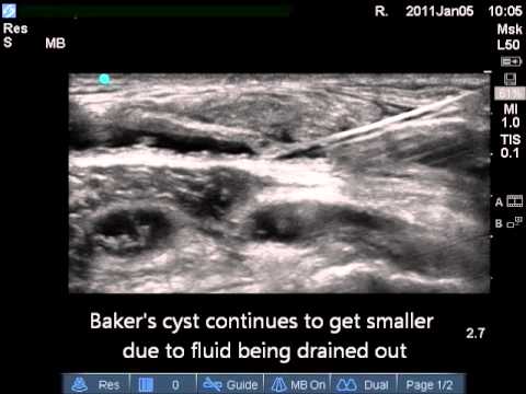 how to drain cyst