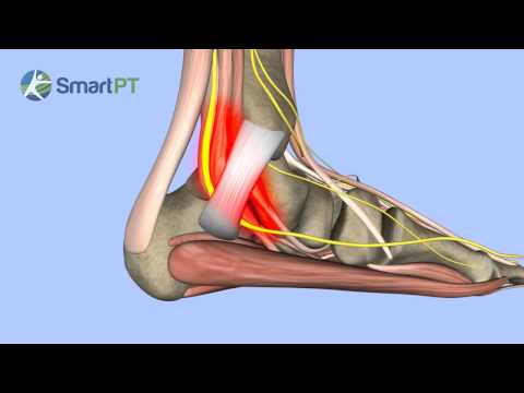 Tarsal Tunnel Syndrome