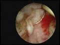 Hysteroscopic Myomectomy