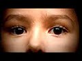 Retinoblastoma