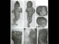Sindrome de Patau
