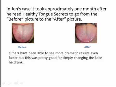 how to cure geographic tongue