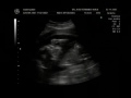 mi ni�a irene ecografia 20 semanas