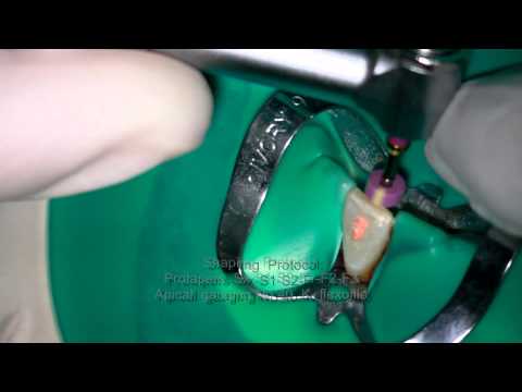 how to dissolve gutta percha