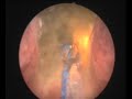 Greenlight HPS Photoselective Vaporization of the Prostate Greenlight HPS Photoselective Vaporization of the Prostate