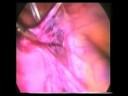 Laparoscopic Hysterectomy | Step 1 | Prof Zion Ben Rafael