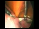 Laparoscopic Hysterectomy | Step 1 | Prof Zion Ben Rafael