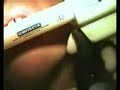 Flap Free Bone Graft II