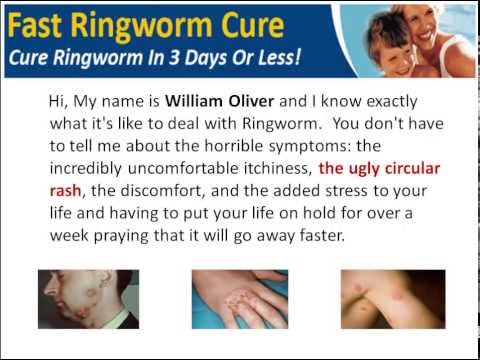 how to cure ringworm at home fast