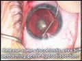 Pediatric Cataract Surgery by Uday Devgan MD, Los Angeles for Posterior Lenticonus