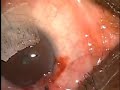 Trabeculectomy Left eye