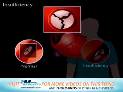 how to treat aortic valve regurgitation