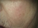 Part 4 - Immediate implantation for an elderly patient.