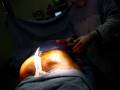 videos de llipo filling of fat-dr. kamal saleh-زرق الدهون وتكبير الارد