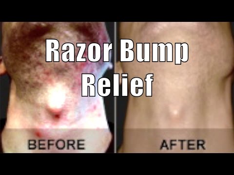 how to relieve razor burn on neck