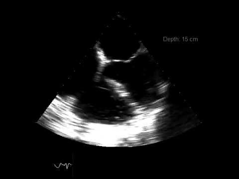how to treat low cvp