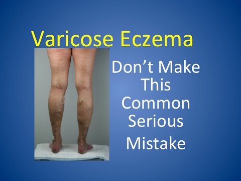 how to treat varicose eczema