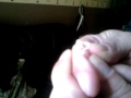 Massive cyst on finger gets popped!