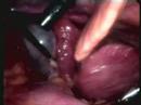 Lap Chole in patient with liver cirrhosis