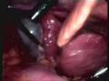 Lap Chole in patient with liver cirrhosis