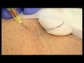 Kleine spataderen  dokter S. Messack