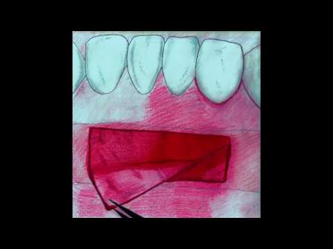 Практикум по пластике мягких тканей десны в области зубов и имплантатов. Часть 14