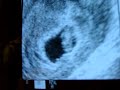 ultrasound 8 weeks 3 days surrogacy
