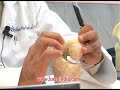 knee replacement in young patients-Dutch patient story You tube