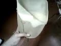 Leg Amputee