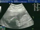 Ultra sonografia de Gabriel( 04 meses)