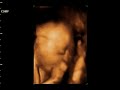 3D-Ultraschallvideo3