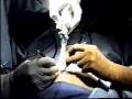laproscopy