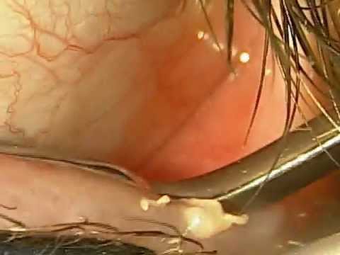 how to unclog eyelid oil glands