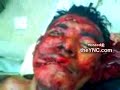Hacked Up By A Machete, Still Talking To Doctors Video Flurl Com Video Search