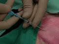 How to insert a central venous catheter line. For full details, visit pocketsnips.org - it's free. Creative Commons licensing - attribution, non-commercial, share-alike.
