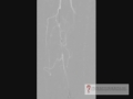 Subintimal Angioplasty