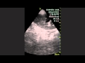 Transplanted Kidney Hydronephrosis Transplanted Kidney Hydronephrosis