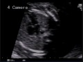Ecografia morfologica : Situs viscerum inversus