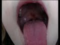 TONSILLITE STREPTOCOCCICA