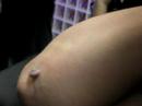 the actual tattooing of the skin tag.