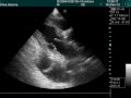 Bilateral Pleural Effusion In Echography Examination Bilateral Pleural Effusion In Echography Examination