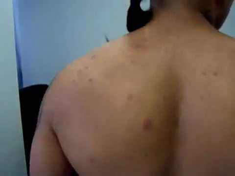 how to treat back acne uk