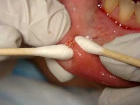 how to dissolve lip filler